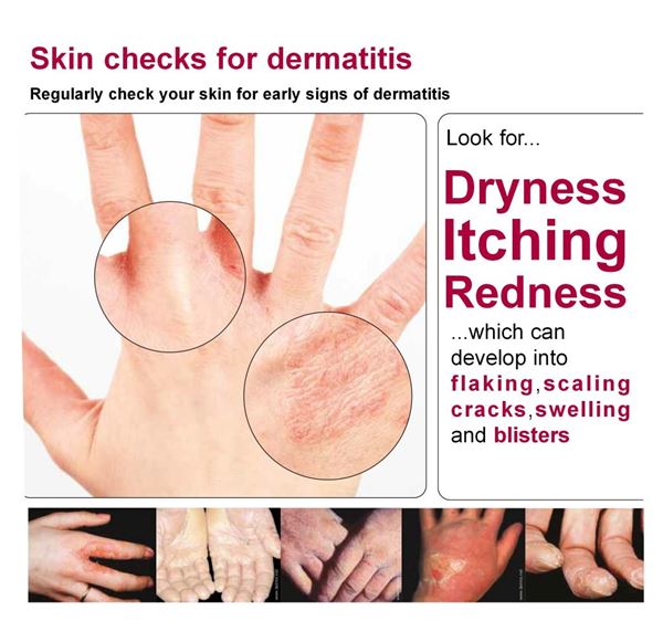 Dermatitis